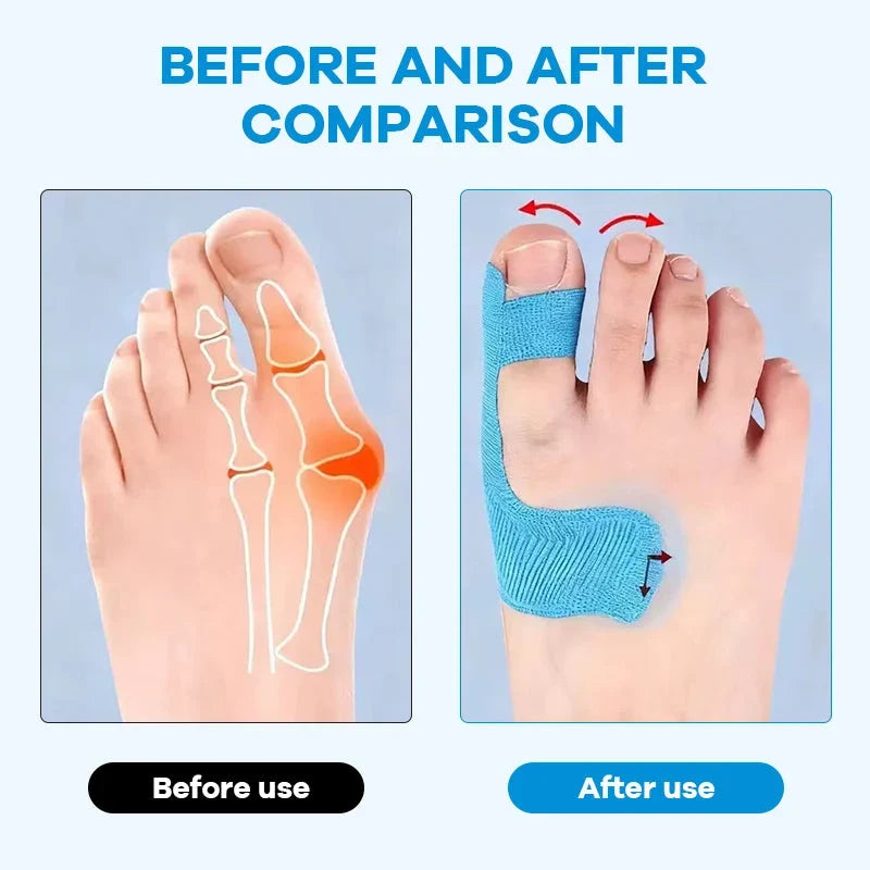 Purpose-Built Pre-cut Bunion Corrector Kinesiology